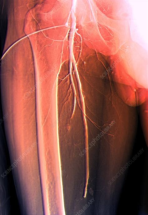 Thrombosis In Femoral Artery Angiogram Stock Image C0096802 Science Photo Library