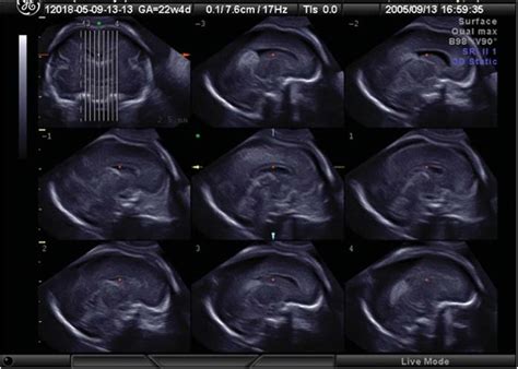 Tomographic Ultrasound Imaging Tui Sagittal View At 22 Weeks