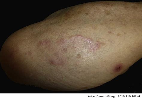 Pseudolymphomatous Granuloma Annulare A Little Known Variant Actas