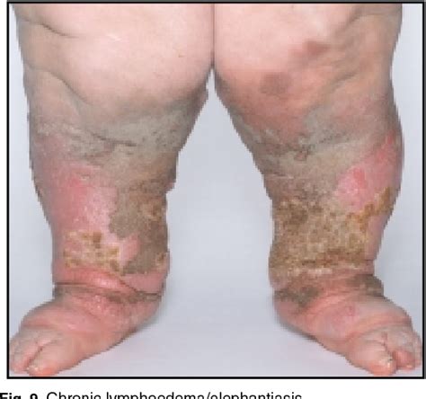 Figure 9 From Bacterial Skin Infections In The Elderly Semantic Scholar