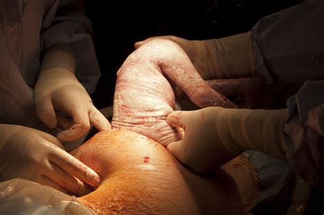 Giving Birth By A Surgical C Section Etta Atlantic Memorial Hospital