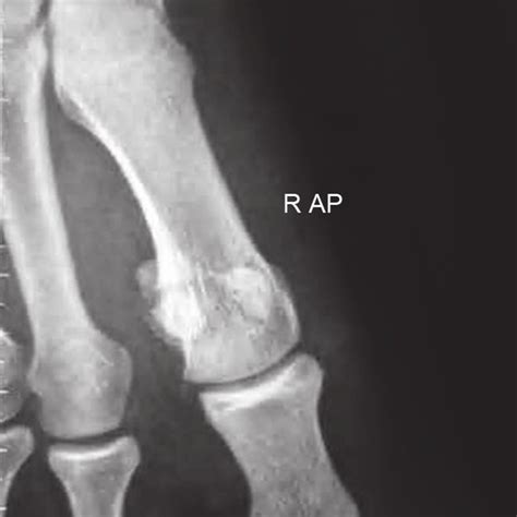 Pdf Stress Fracture Of The Fibular Sesamoid Bone Of The Foot In