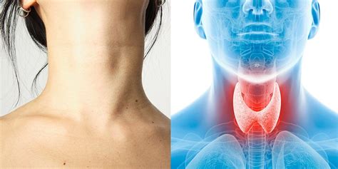 9 Signs Your Thyroid Is Out Of Whack Thyroid Nodules Thyroid Issues