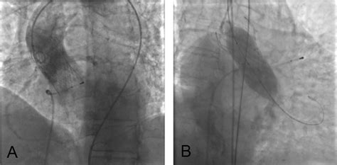 Mitraclip Implantation For The Treatment Of New Onset Systolic Anterior