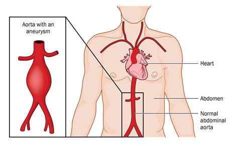 Aneurisma Da Aorta Ascendente