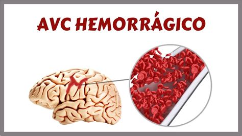 Accidente Cerebro Vascular Hemorragico Kicklopers