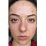 My Skins Journey  Week 37 Banish Acne Scars