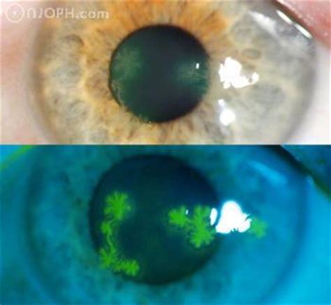 Herpes simplex keratitis is caused by recurrent infection of the cornea by herpes simplex virus (hsv). Atlas of Ophthalmology