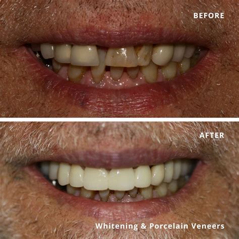 Porcelain Veneers Before And After Town House Dental