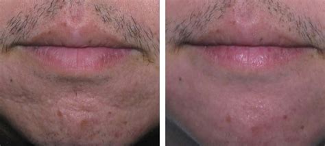 Acne And Acne Scars Before And After Kingsway Dermatology