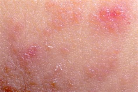 Eczema Types What Does Eczema Look Like Eucerin Uk