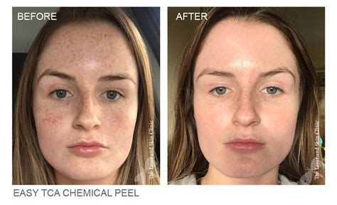Watch See The Amazing Effects Of A Tca Chemical Peel Gossie