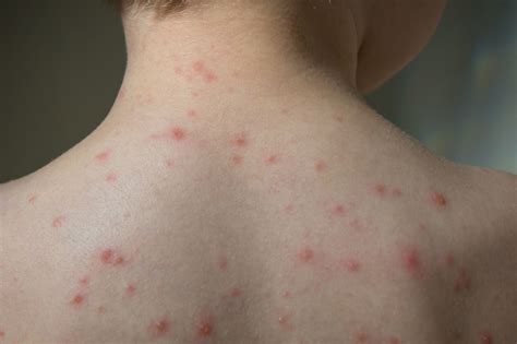 Chickenpox Outbreak At School Linked To Vaccine Exemptions Primary