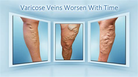 Varicose Veins Can Lead To Deadly Blood Clots If Left
