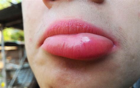 29 How To Treat A Swollen Lip After Dental Work 122022 Ôn Thi Hsg