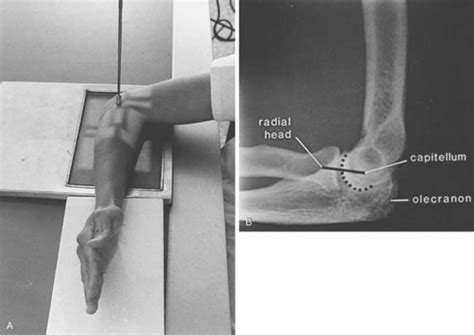 Diagnostic Imaging Of The Elbow Musculoskeletal Key
