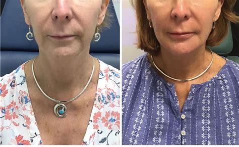 Y Lift ® Nonsurgical Facelift Lunchtime Facelift View Patient Photos