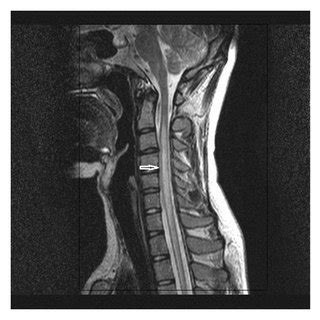 T2 Weighted Axial A And Sagittal B MR Images Of The Cervical Spine