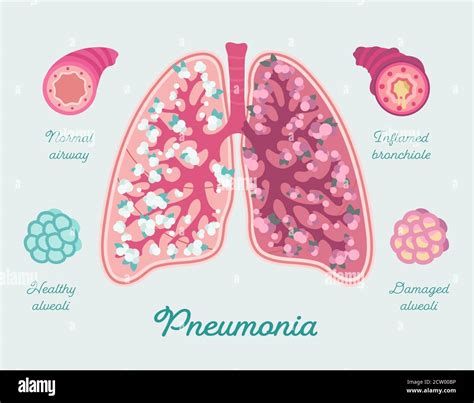 Pneumonia In Human Lungs Inflammation Lungs Including Due To Covid
