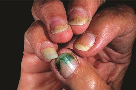 Pseudomonas Aeruginosa Nail Infection Nail Ftempo
