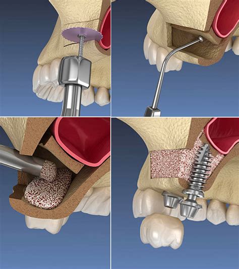 Sinus Lift Surgery For Dental Implant Treatment In India Fms Dental