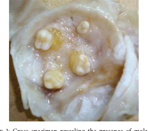 Figure 1 From Ectopic Teeth In Ovarian Teratoma A Rare Appearance