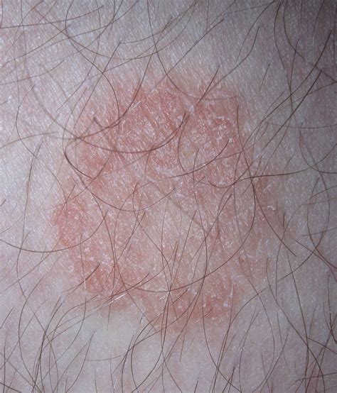 What Does Ringworm Look Like When Healing Pictures Symptoms