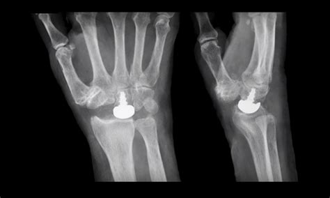 Capitate Implant In Advanced Slac Wrist —