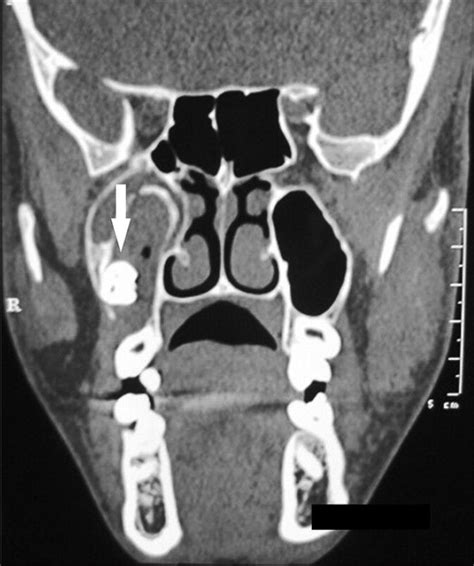 Infected Dentigerous Cyst Of Maxillary Sinus Arising From An Ectopic
