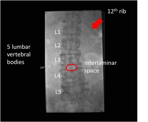 Fluoroscopic Guided Lumbar Puncture Learn Neuroradiology
