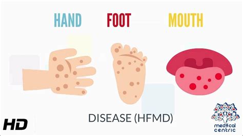 Hand Foot And Mouth Disease Causes Signs And Symptoms Diagnosis