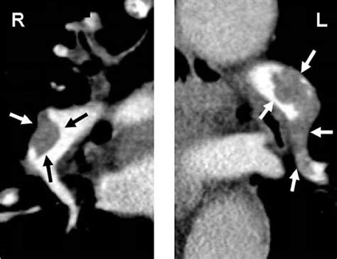 Ct Pulmonary Angiogram Showing Thrombus White And Black Arrows As