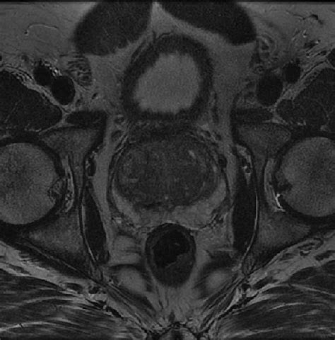 An Example Of A Prostate T2 Weighted Mr Image Taken In The Transversal