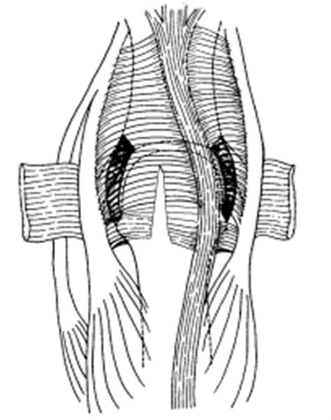 Sagittal Band Rupture Hand Orthobullets