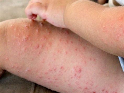 Hand Foot And Mouth Disease Rash Pictures Photos