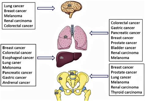 Organ Specific Cancer Treatments Certain Advanced Cancer
