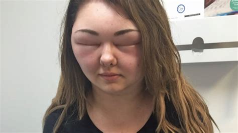 Woman Blinded After Allergic Reaction To Hair Dye Causes Head To Swell