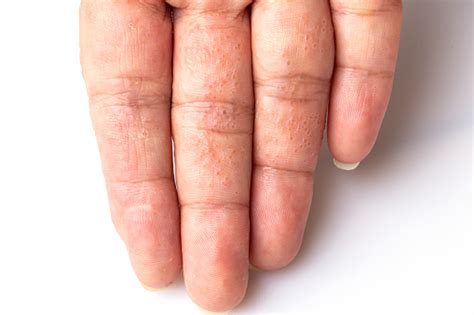 Close Up Atopic Dermatitis On Finger Also Known As Atopic Eczemaskin