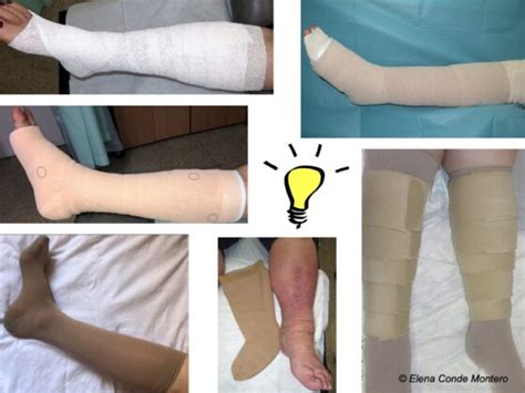 6 Reasons Why A Venous Ulcer Does Not Heal Despite Compression Therapy