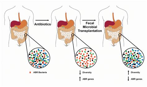 Fecal Microbial Transplantation A Novel Approach To Eradicate