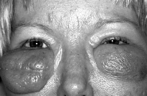 Grotesque Bilateral Eyelid Swelling As A Symptom Of Munchausens