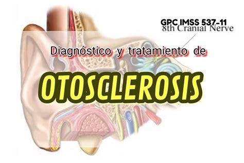 Otosclerosis Dr Galvan
