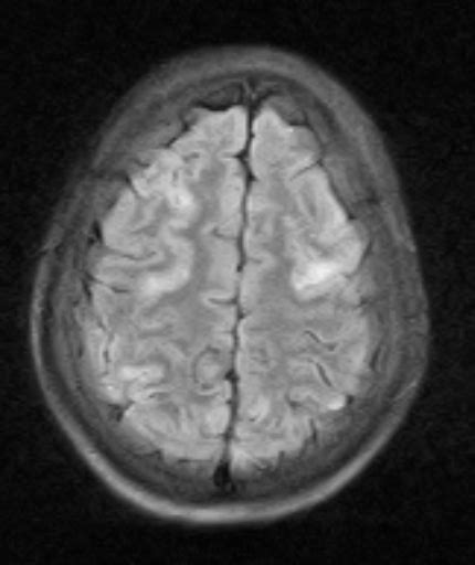 Posterior Reversible Encephalopathy Syndrome Pres Sumers Radiology