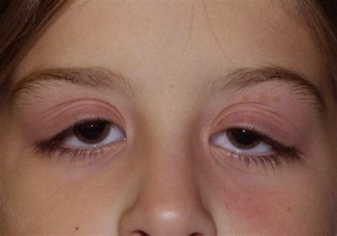 Swollen Eyelid Symptoms Treatment Pictures Causes Healdove