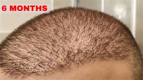 6 Months Hair Transplant Results Youtube
