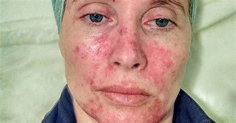 Sun Worshipping Mum Shares Graphic Pictures Of Skin Damage Treatment To