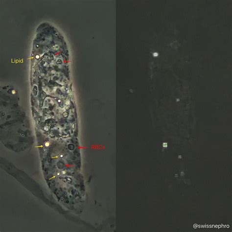 Hyaline Granular Cast With Lipid Droplets And Some Rbc Remnants