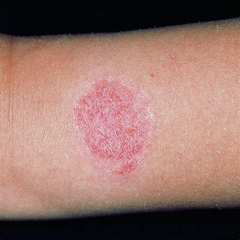 Causes And Cures Of Rashes