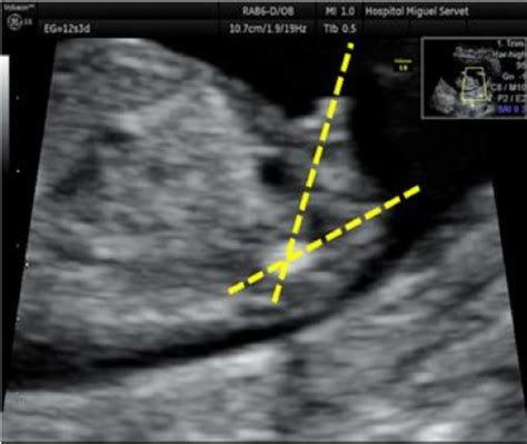 Male Sex Ultrasound Identification Of The Male Sex At The First
