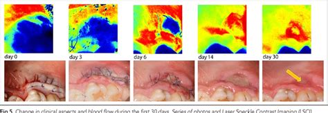 Figure From Assessment Of Palatal Mucosal Wound Healing Following